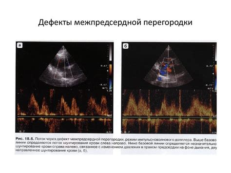 Септальные дефекты. Дефекты межпредсердной перегородки - презентация онлайн