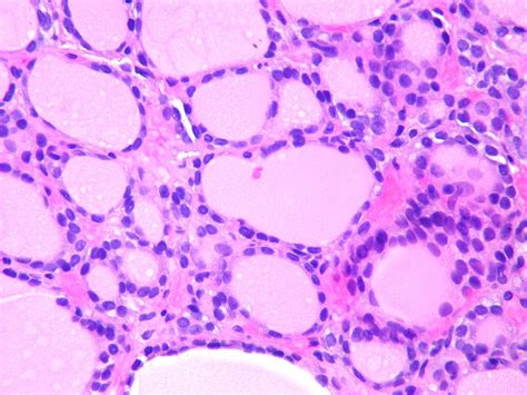 Anaplastic Thyroid Cancer Differential Diagnosis Wikidoc