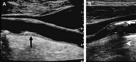 Non Invasive Ultrasound Images Of Carotid Lipid Rich A And Calcified