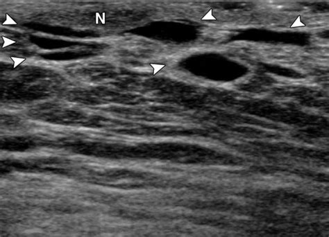 Imaging Approaches To Diagnosis And Management Of Common Ductal