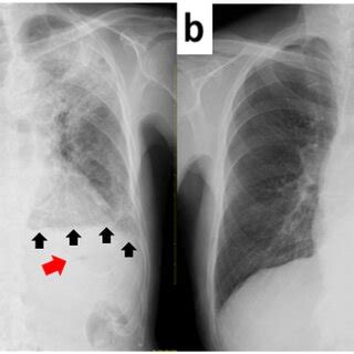 A Chest Radiograph Postero Anterior View Revealing Consolidation In