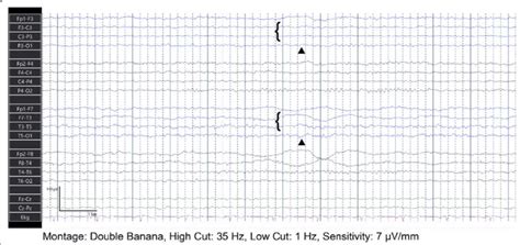 Follow Up Eeg Three Months After Discharge Follow Up Eeg 3 Months