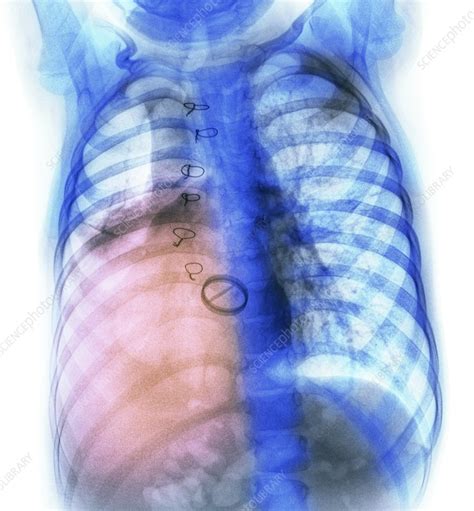 Pneumonia X Ray Stock Image C011 9719 Science Photo Library