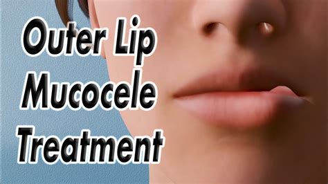 Outer Lip Mucocele Lip Bump Surgical Treatment Youtube