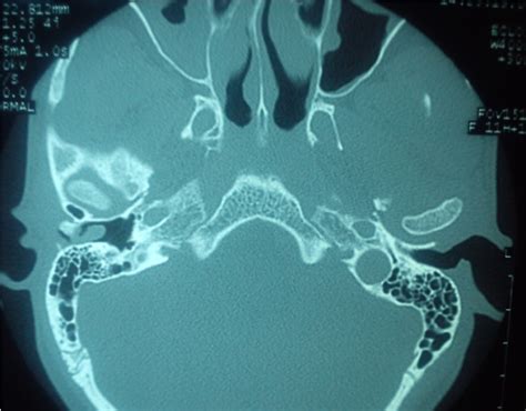 Osteoma Of The External Auditory Canal Masquerading As An Aural Polyp