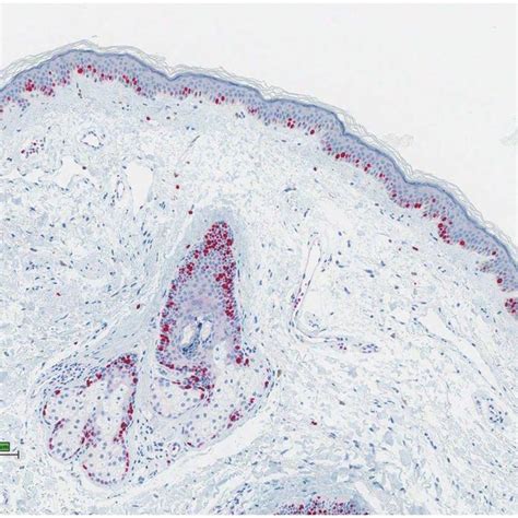 Section of skin with desmoplastic squamous cell carcinoma, hematoxylin ...