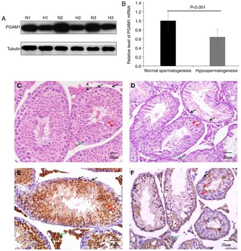 PGAM1 Knockdown Is Associated With Busulfaninduced Hypospermatogenesis