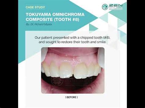 Zen Dental Case Study Tokuyama Omnichroma Composite Tooth 8 YouTube