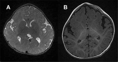 Clinical And Neuroradiological Features Of The 9p Deletion Syndrome