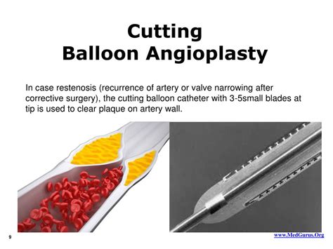 Ppt Facts On Angioplasty Powerpoint Presentation Free Download Id