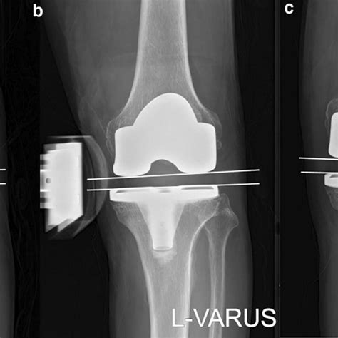 Valgus And Varus Stress Radiographs Using A Telos Stress Device To Download Scientific Diagram