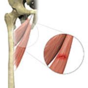 Adductor Muscle Strain Photograph By Medical Graphics Michael Hoffmann