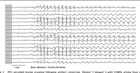 Pdf Eegfmri Study On The Interictal And Ictal Generalized Spike Wave