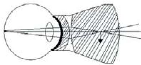 Panfundoscope Lens With A Biconvex Spherical Anterior Lens Element Download Scientific Diagram