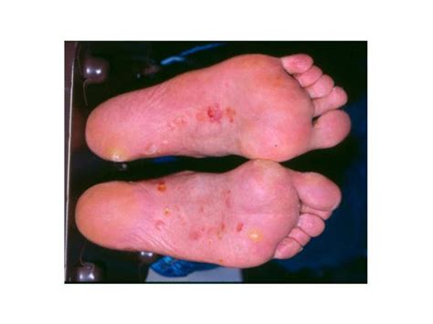 Tinea Pedis Types