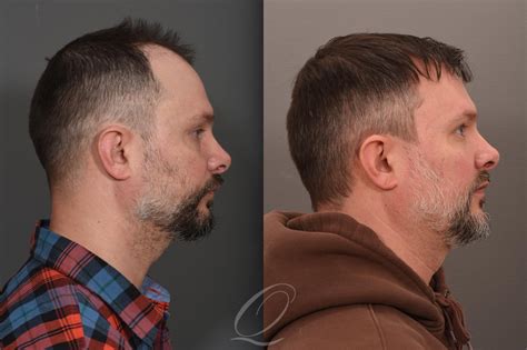 Male FUE Hair Transplant Before And After Pictures Case 1001686