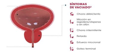 Hiperplasia prostática benigna en diabetes Esperanza en diabetes