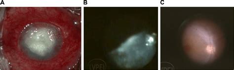 Panel Shows Endophthalmitis With A Post Glue Application Perforated Download Scientific Diagram