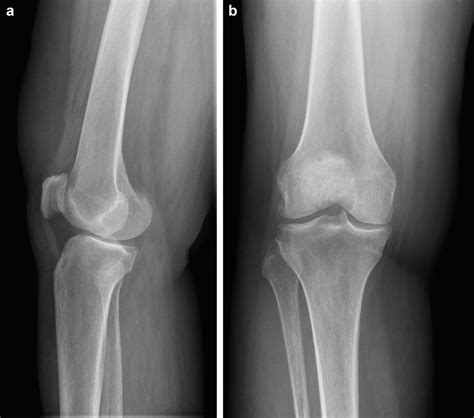 A B Preoperative Lateral And Anteroposterior Radiographs Of The Right