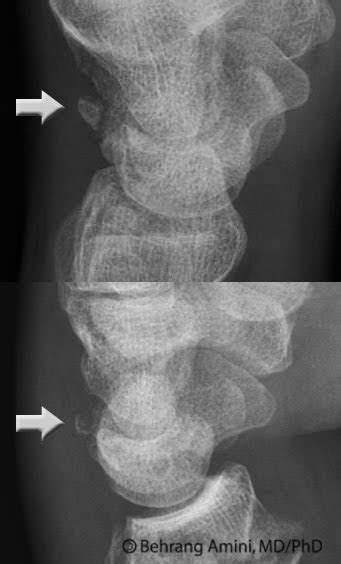 Roentgen Ray Reader: Triquetral Fracture