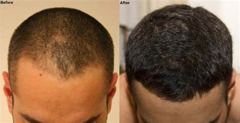 1000 Graft Fue Hair Transplant To Restore Hairline Alvi Armani Hair Transplant Los Angeles