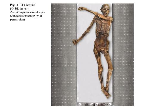 Life and Diseases of the Neolithic Glacier Mummy Ötzi