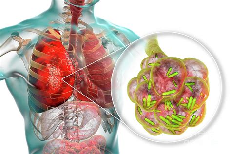 Bacterial Pneumonia Photograph By Kateryna Konscience Photo Library