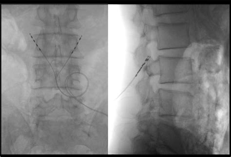 Fluoroscopic Anterior Posterior View Left And Lateral View Right Download Scientific