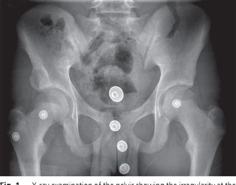 Figure 1 From Apophyseal Avulsion Fracture Of The Anterior Inferior