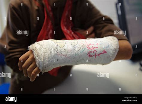 Broken Arm In A Cast Covered With Signatures Stock Photo 32309106 Alamy