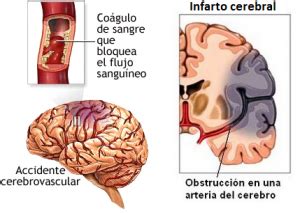 Isquemia Cerebral Cirugía Neurológica mx