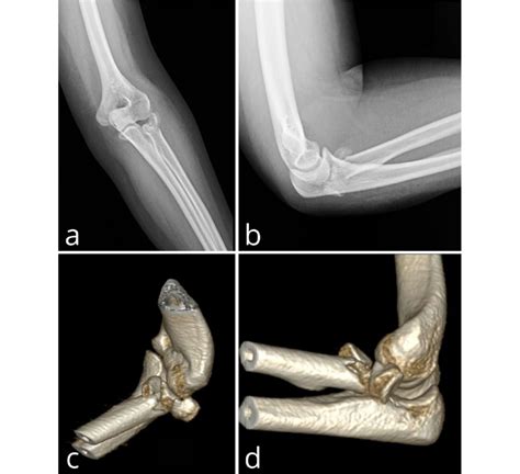 Anteroposterior A And Lateral B X Ray And D Ct C D Images Of A