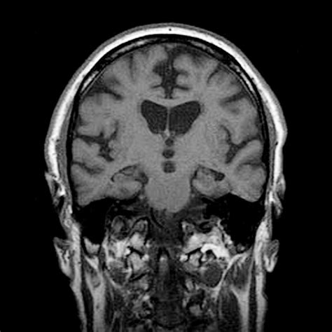 Alcoholic Dementia, Mri Scan Photograph by Du Cane Medical Imaging Ltd - Pixels