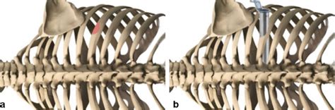 Schematic Illustration Of Partial Resection Of The Lower Rib A And