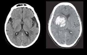 Neurology Neuroanatomic Orientation And Neuroimaging Flashcards Quizlet