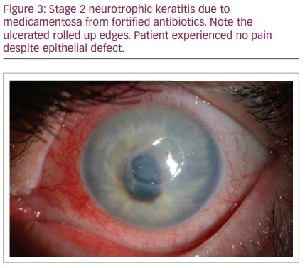 Neurotrophic Ulcer Cornea