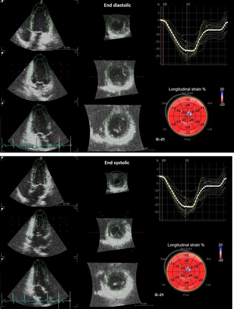 Three Dimensional Speckle Tracking Echocardiography The Images