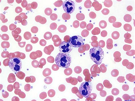 Paraneoplastic Leukemoid Reactions Induced By Cytokine Secreting