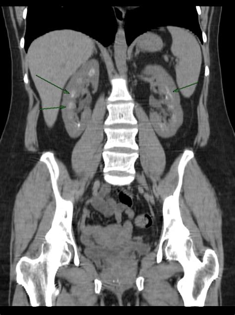 Nephrocalcinosis - wikidoc