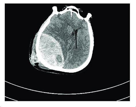 The Ct Examination Of One Patient With Cerebral Contusion And Download Scientific Diagram