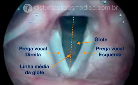 Anatomia Das Cordas Vocais - Histologia Das Cordas Vocais