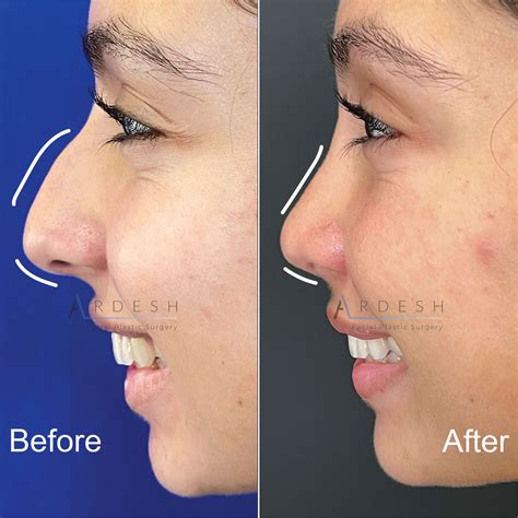 Rhinoplasty Before And After Ardesh Facial Plastic Surgery