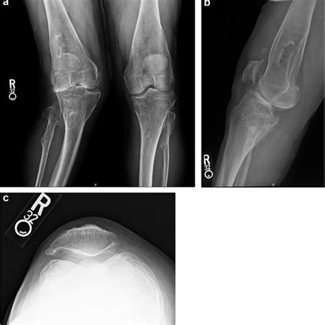 Postoperative Ap A Lateral B And Sunrise C Radiographs Of The