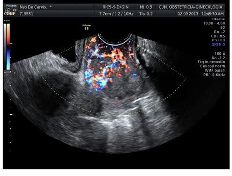 Transvaginal Color Doppler From A Cervical Cancer Showing An Abundant