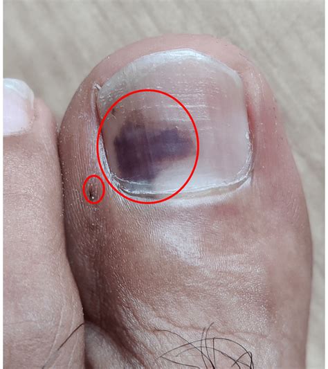 Albums 103 Pictures Photos Of Toe Nail Melanoma Updated