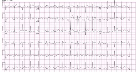 Benign Early Repolarization