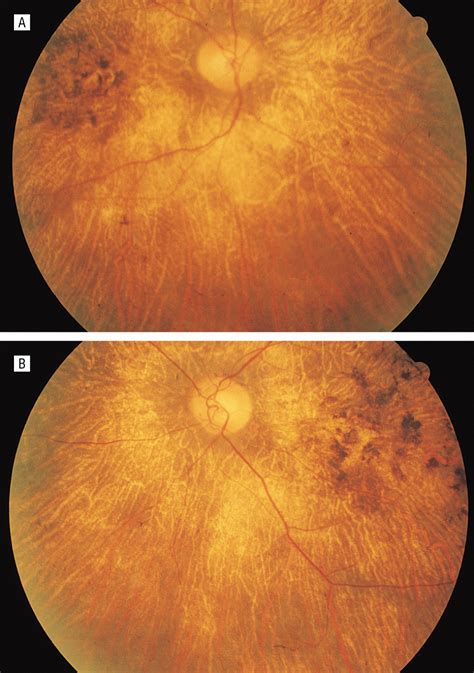 Autoimmune Retinopathy Patients With Antirecoverin Immunoreactivity