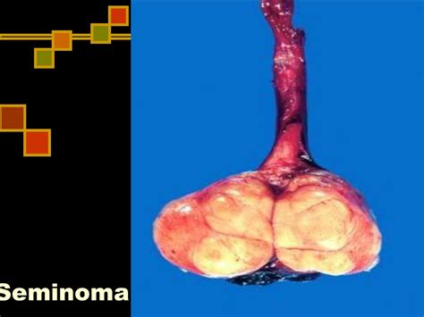 Ppt Testicular Carcinoma Powerpoint Presentation Free Download Id