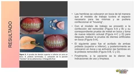 Aditamentos Protesis Removible Dentales Ppt