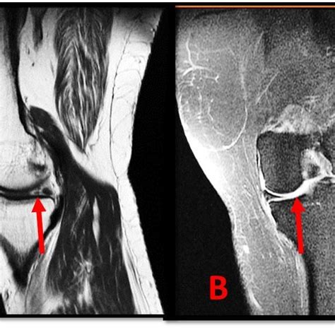 A: MRI T2 weighted Sagittal image showing the radial tear of the ...